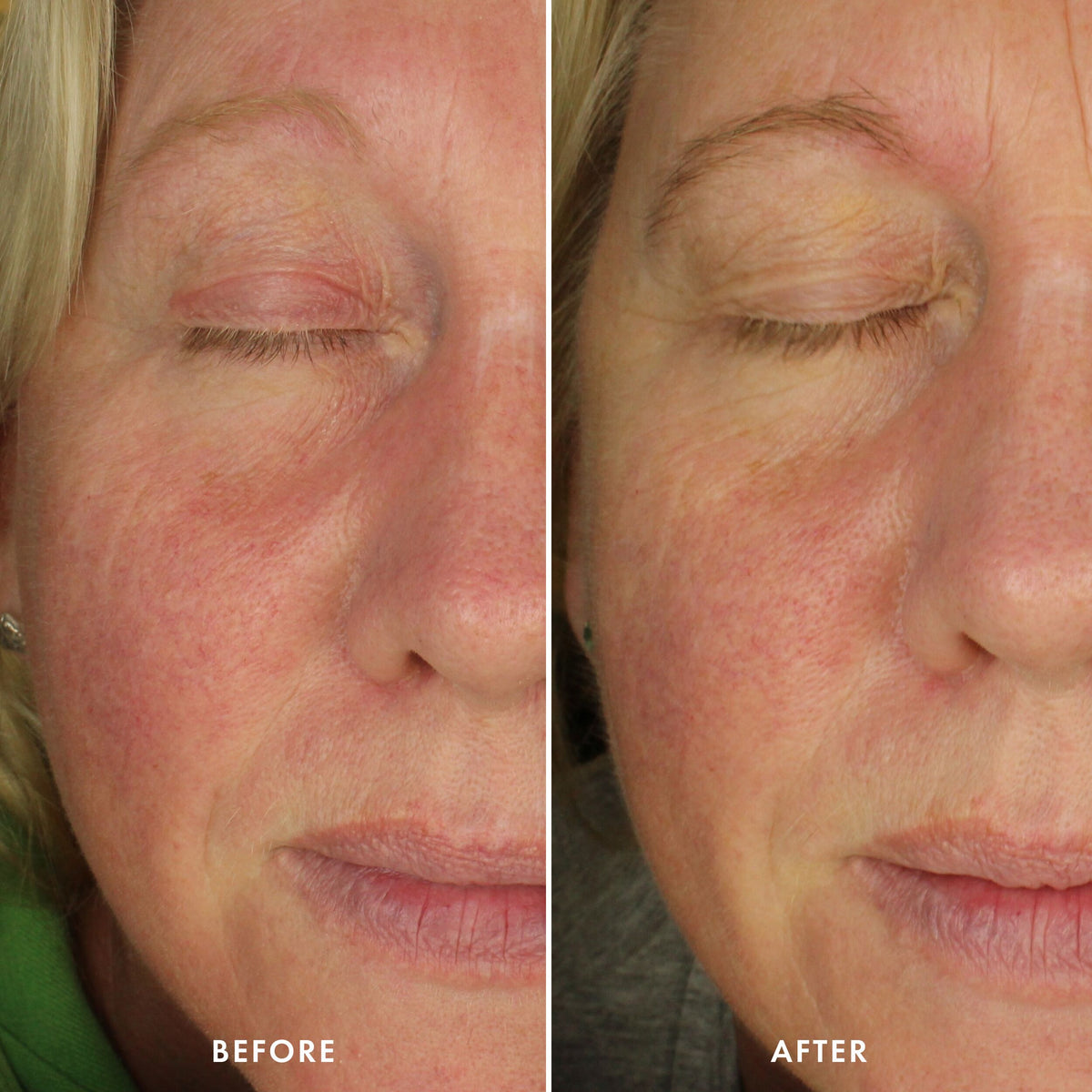 Happy Face 10% Azelaic Acid Skin-Clearing Gel-Cream